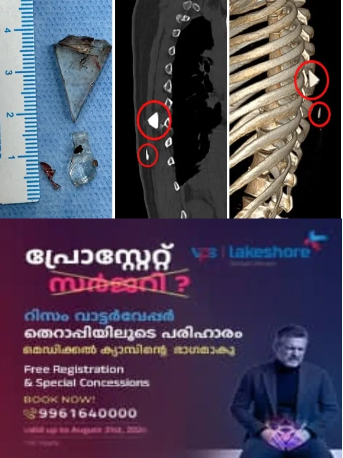 വേദന നിറഞ്ഞ 12 വർഷം;കാരണമറിയാതെ   ആശുപത്രികളിൽ നിന്ന്  ആശുപത്രികളിലേക്ക്; ഒടുവിൽ രക്ഷകരായി  വി.പി.എസ് ലേക്‌ഷോർ ഹോസ്പിറ്റൽ;യുവതിയുടെ നട്ടെല്ലിൽ നിന്ന് ഗ്ലാസ് കഷ്ണങ്ങൾ നീക്കം ചെയ്ത് വി.പി.എസ് ലേക്‌ഷോറിലെ വിദഗ്ധ സംഘം
