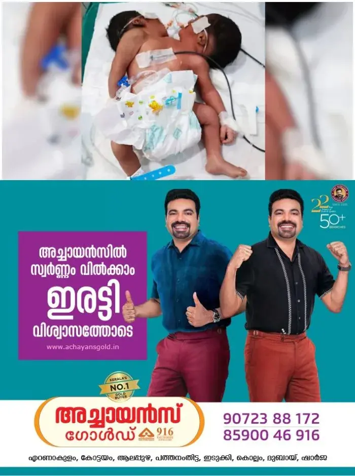 രണ്ട് തലകളുമായി കുഞ്ഞ് ജനിച്ചു; സംഭവം ഒഡീഷയിൽ, 3 ലക്ഷം ജനനങ്ങളിൽ ഒരിക്കൽ മാത്രം സംഭവിക്കുന്ന അപൂർവ്വ അവസ്ഥയെന്ന് ഡോക്ടർമാർ 
