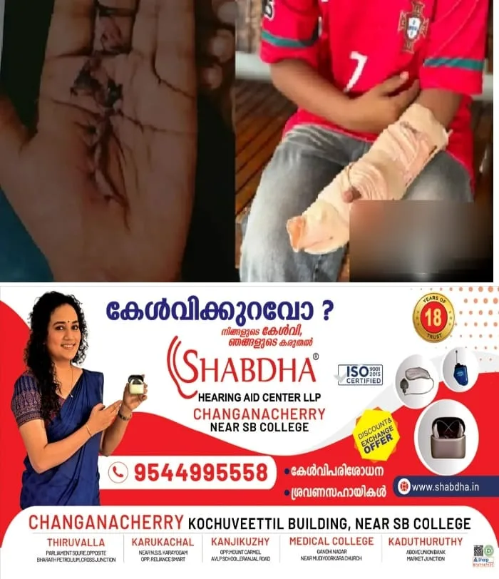 'ഒമ്പതാം ക്ലാസുകാരന്റെ വിരലിന്റെ ചലനശേഷി നഷ്ടമായി'; കോഴിക്കോട് കൊയിലാണ്ടി താലൂക്ക് ആശുപത്രിയില് ചികിത്സാപ്പിഴവെന്ന് പരാതി
