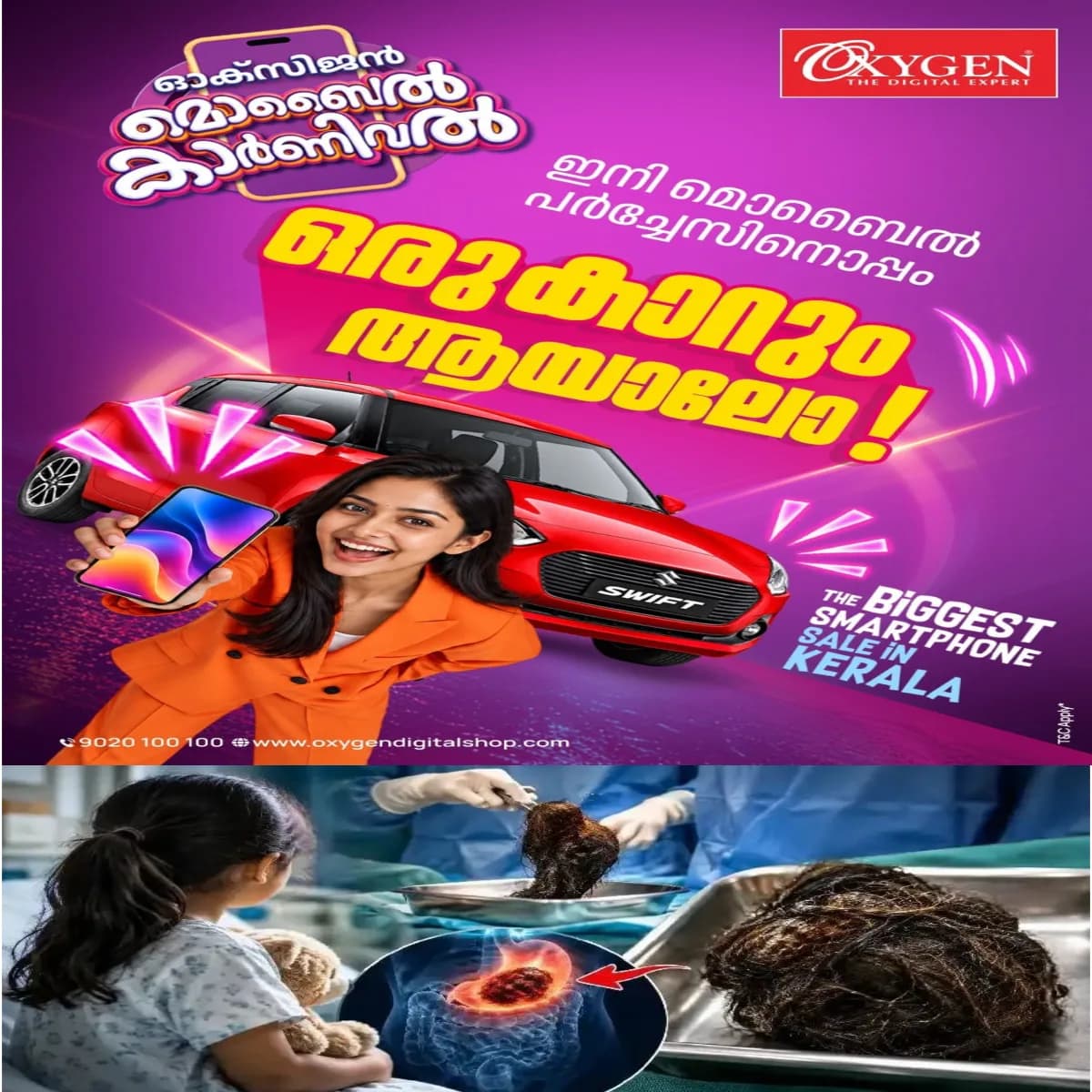 തുടർച്ചയായി വയറുവേദനയും ഛർദിയും അനുഭവപ്പെട്ടതിനെ തുടർന്ന് ചികിത്സയ്ക്കെത്തിച്ച ഒൻപതുകാരിയുടെ വയറ്റിൽനിന്ന് ശസ്ത്രക്രിയയിലൂടെ നീക്കം ചെയ്തത് ഏകദേശം ഒരു കിലോഗ്രാം ഭാരമുള്ള തലമുടിക്കെട്ട്.