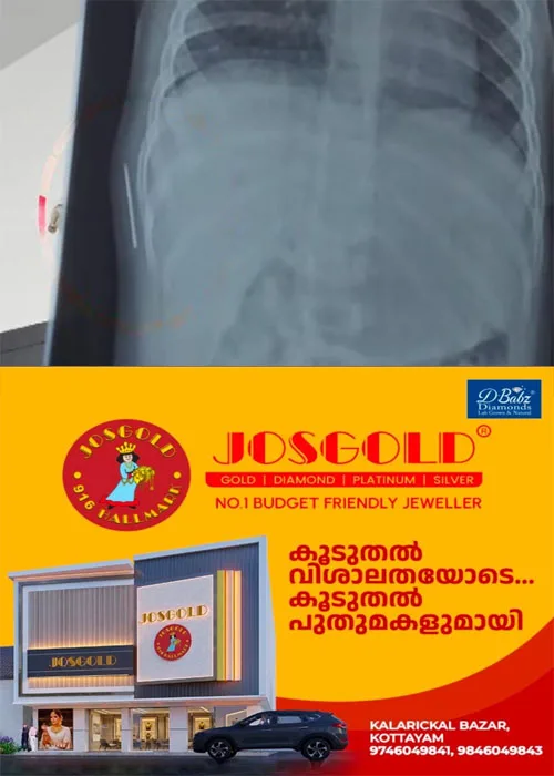 ഒരു വയസുള്ള കുഞ്ഞിന്റെ ശരീരത്തില് സൂചി; കോട്ടയം മെഡിക്കല് കോളജില് വീണ്ടും ചികിത്സാ പിഴവ്; കുഞ്ഞ് വേദന സഹിച്ചത് ഒരു വര്ഷത്തോളം;ഡെപ്യൂട്ടി സൂപ്രണ്ടിന്റെ നേതൃത്വത്തില് അന്വേഷണം ആരംഭിച്ചു