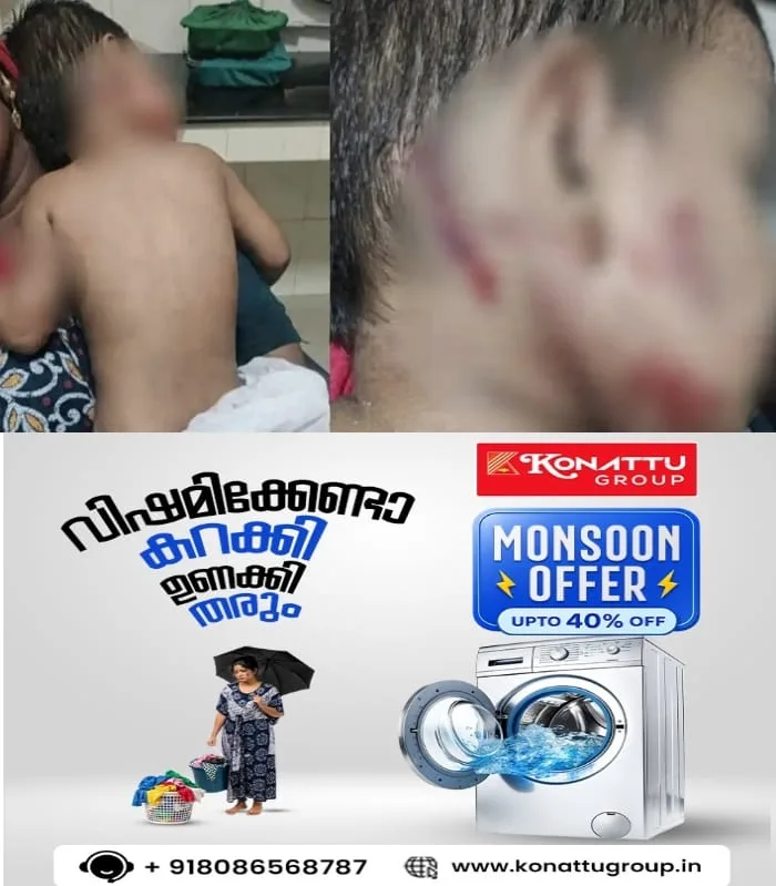 വീണ്ടും തെരുവുനായ ആക്രമണം; കാസര്കോട് വീട്ടുറ്റത്ത് കളിച്ചുനിന്ന ഒന്നരവയസുകാരന്റെ മുഖം കടിച്ചുകീറി